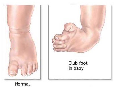 ClubFoot - Bazarganan Hospital