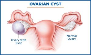 Chocolate Cysts : Causes, Symptoms & Treatment